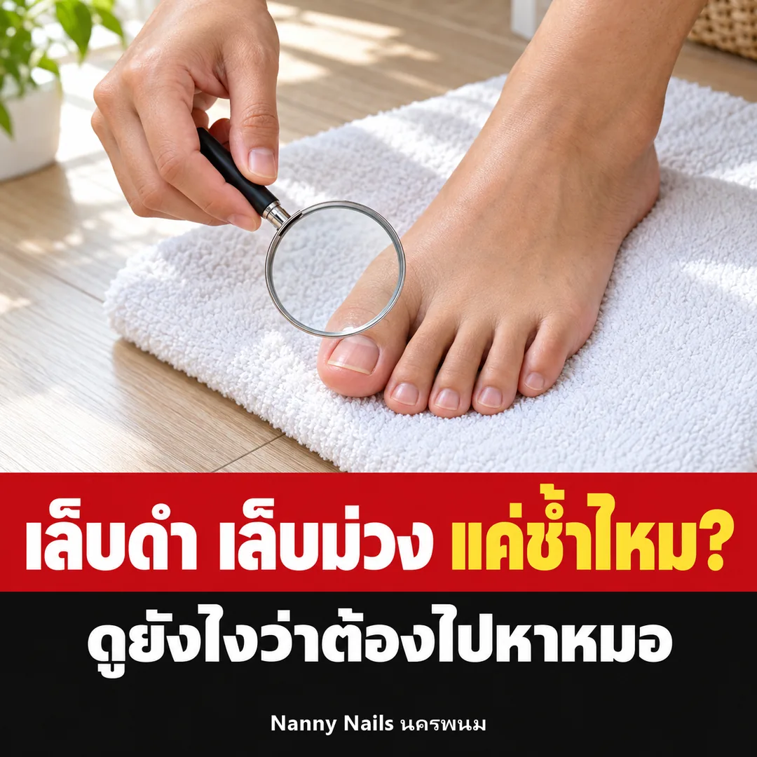 ปกบทความ เล็บดำ เล็บม่วง แค่ช้ำไหม ดูยังไงว่าต้องไปหาหมอ Nanny Nails นครพนม