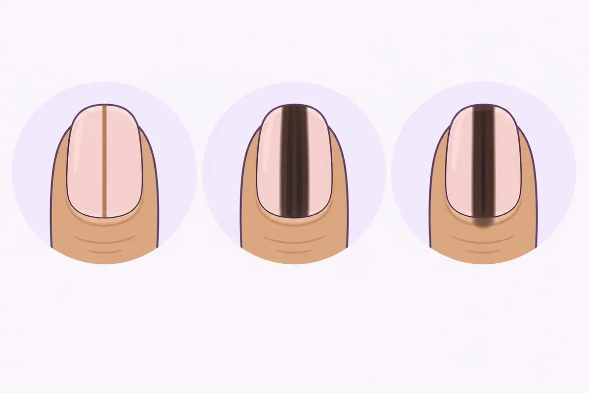 Diagram of three dark lines on a fingernail: a thin even line, a wide uneven band, and a band with colour spreading onto the skin at the base, Nanny Nails Nakhon Phanom